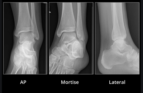 ankle-injuries