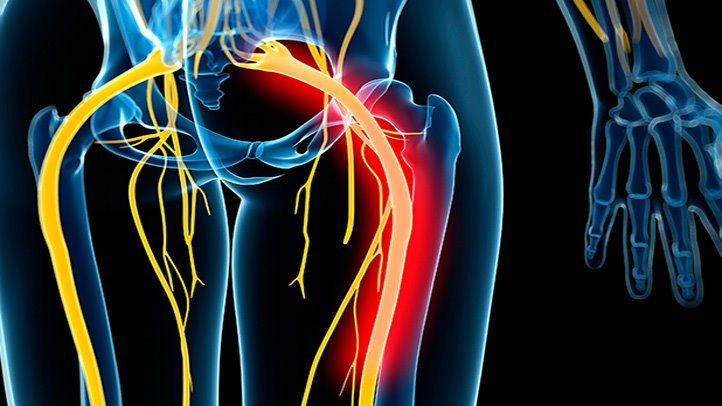 sciatic nerve pain